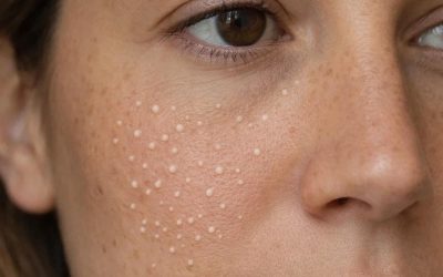 Produits pour éliminer les miliums, ces petits boutons blancs gênants sur la peau.