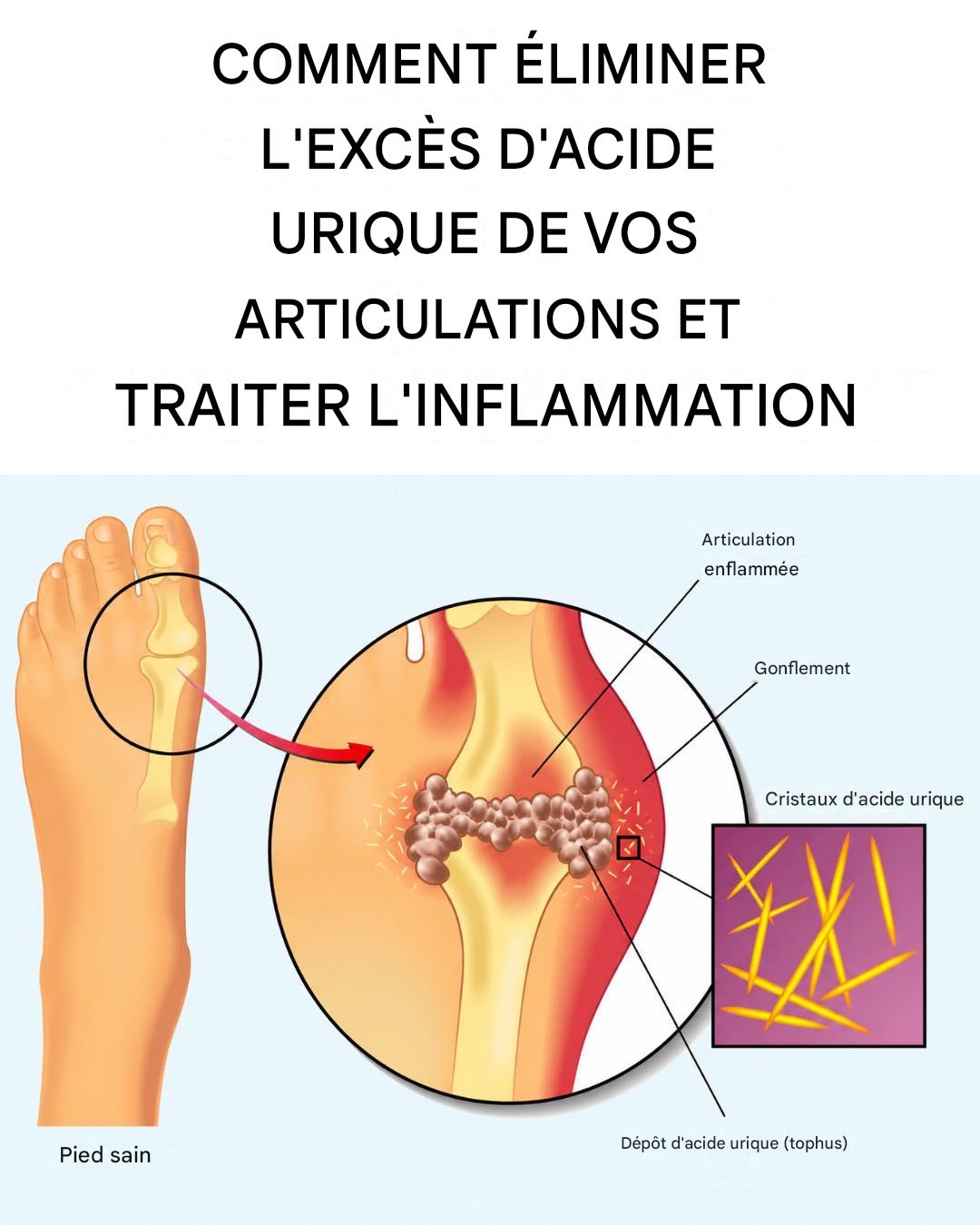 Comment éliminer l’acide urique et traiter l’inflammation articulaire