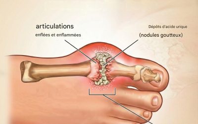 7 remèdes naturels pour éliminer l’acide urique, cause de l’arthrite