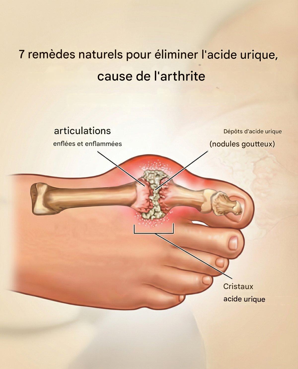 7 remèdes naturels pour éliminer l’acide urique, cause de l’arthrite