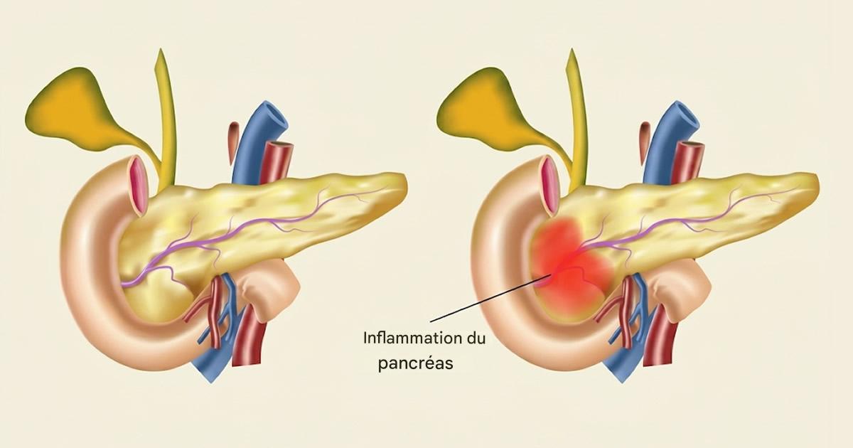 8 symptômes d’un pancréas qui ne fonctionne pas correctement et que faire