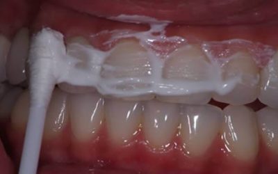 Le remède naturel qui élimine le tartre, soigne la gingivite et blanchit les dents