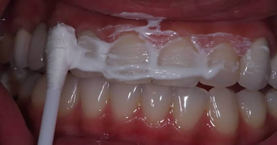 Le remède naturel qui élimine le tartre, soigne la gingivite et blanchit les dents
