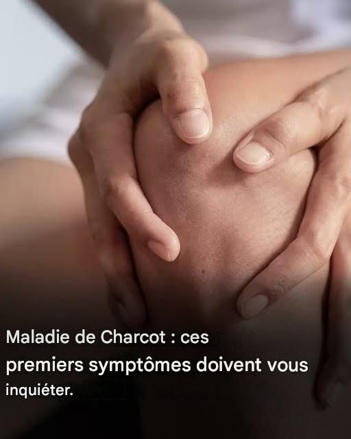 Maladie de Charcot : voici les premiers symptômes de cette maladie.