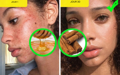 6 problèmes de peau courants et 6 masques efficaces à utiliser chez soi pour y remédier.