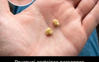 Calculs biliaires : que sont-ils et comment s’en débarrasser ?