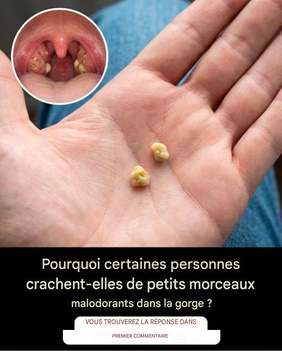 Calculs biliaires : que sont-ils et comment s’en débarrasser ?